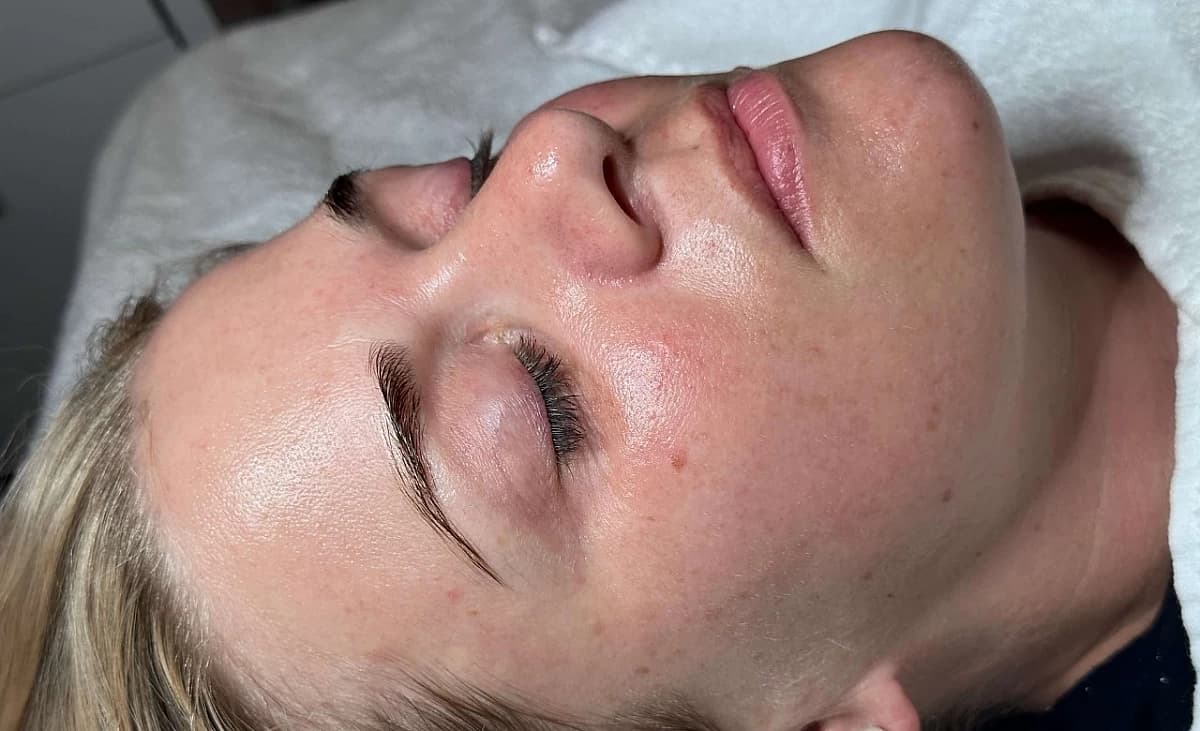 Gesicht von Kundin nach Microdermabrasion-Behandlung.